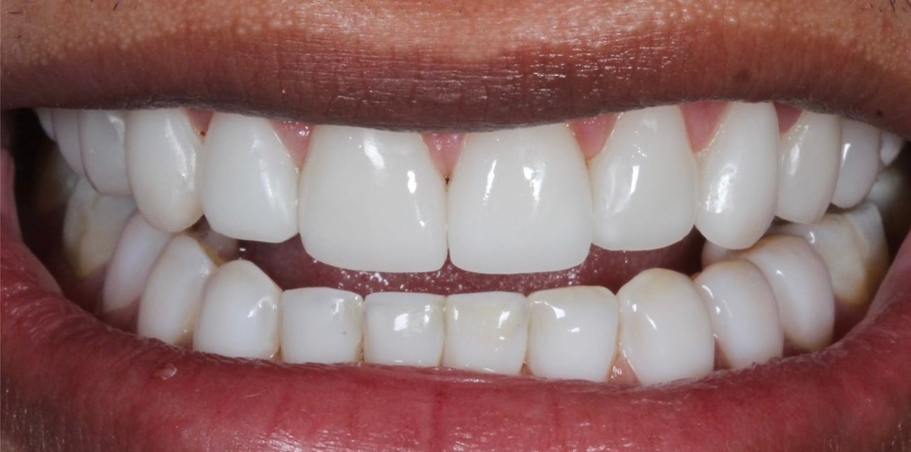 Sonrisa después del tratamiento de diseño de sonrisa