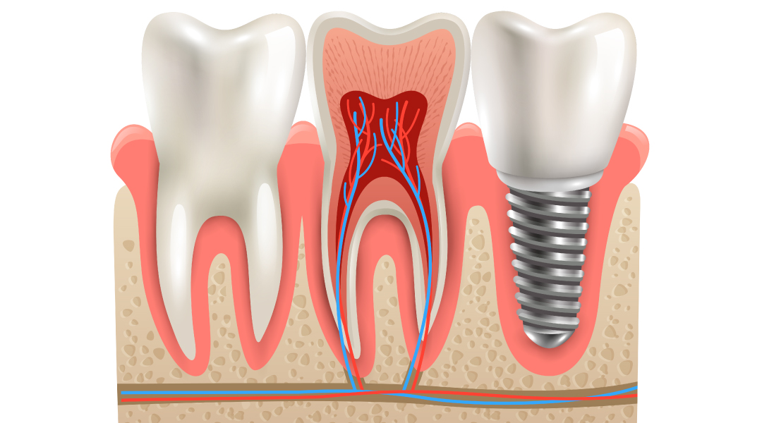 Implante dental al lado de un diente sano.